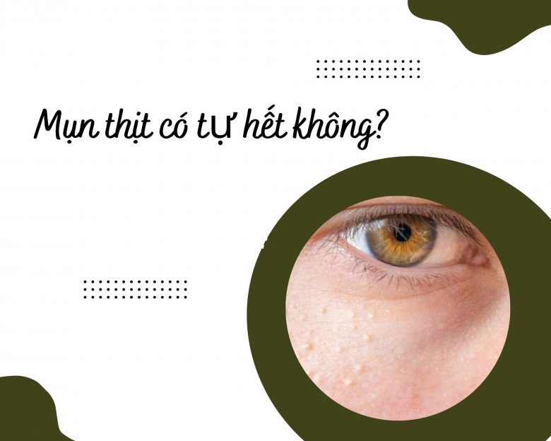 15 Cách trị mụn thịt tận gốc tại nhà hiệu quả nhất hiện nay - 2