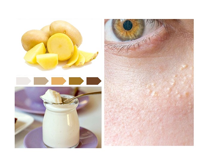 15 Cách trị mụn thịt tận gốc tại nhà hiệu quả nhất hiện nay - 16