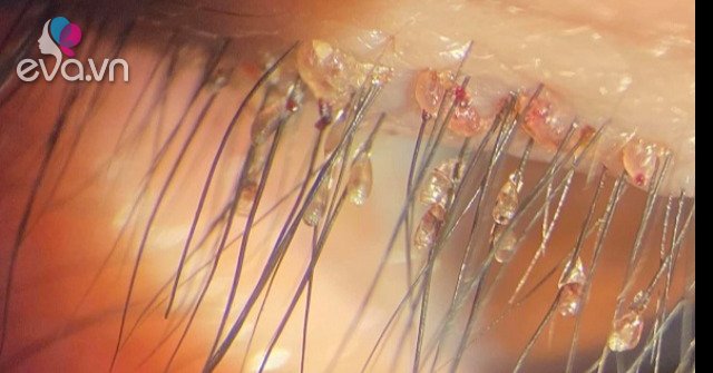 Itchy eyes, the man went to the doctor to “explore” when he discovered nearly 100 pubic lice living in his eyelids