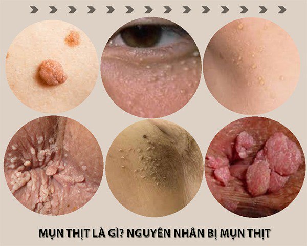 15 Cách trị mụn thịt tận gốc tại nhà hiệu quả nhất hiện nay - 1