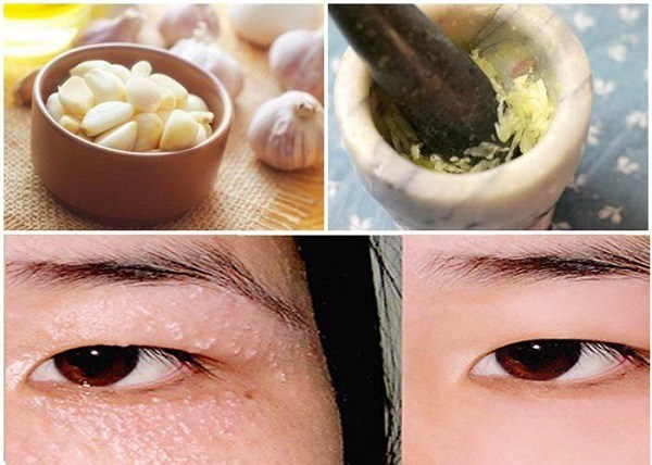 15 Cách trị mụn thịt tận gốc tại nhà hiệu quả nhất hiện nay - 4