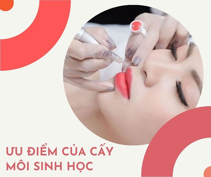 Cấy môi sinh học là gì? Chuyên gia nói gì về phương pháp … – Eva