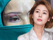 Làm đẹp - Nâng cung chân mày chống lão hóa, quý cô trung niên nhận về đường rạch ngang tới thái dương