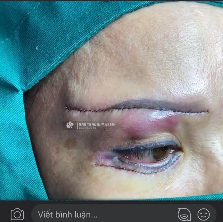 Anti-aging eyebrow lift, middle-aged lady received a horizontal incision to the temple - 3