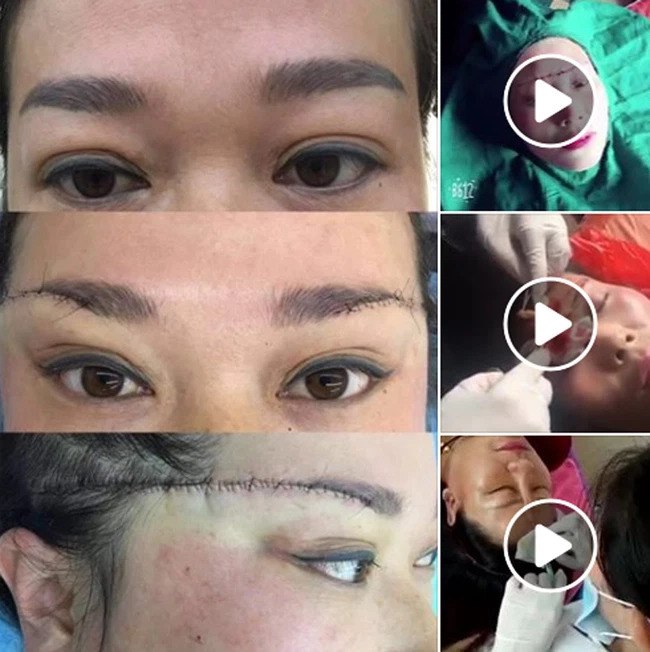 Anti-aging eyebrow lift, middle-aged lady received a horizontal incision to the temple - 6