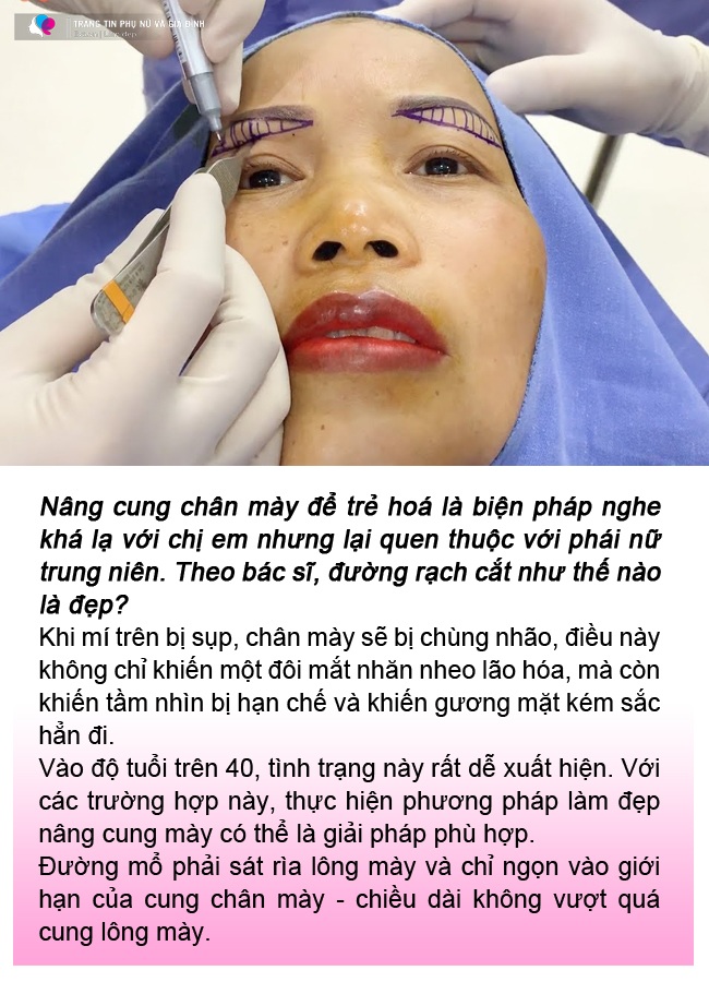 Anti-aging eyebrow lift, middle-aged lady received a horizontal incision to the temple - 8