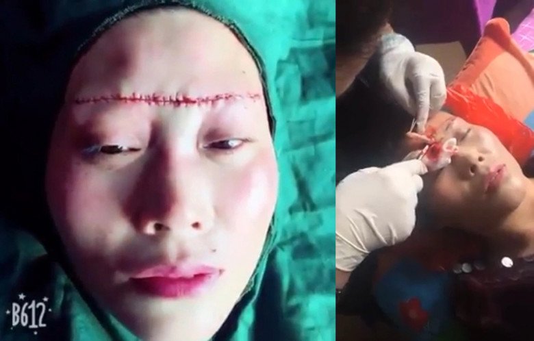 Anti-aging eyebrow lift, middle-aged lady received a horizontal incision to the temple - 7