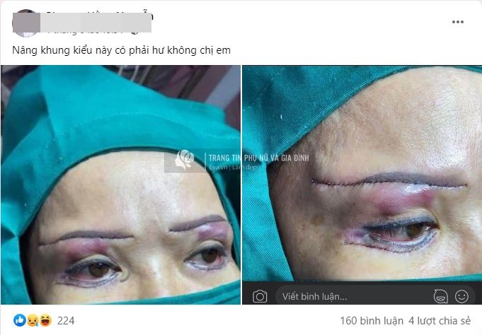 Anti-aging eyebrow lift, middle-aged lady received a horizontal incision to the temple - 1