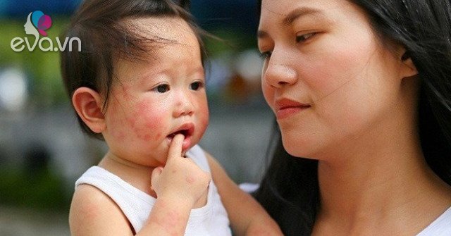 Do children with hand, foot and mouth disease abstain from bathing?