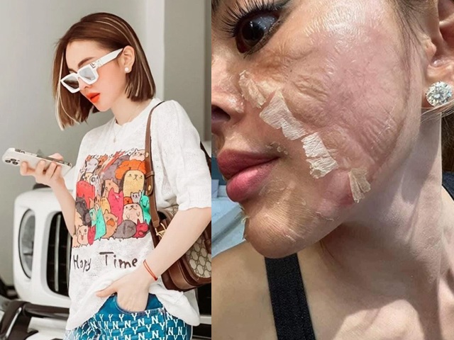 Hotgirl tự peel da tại nhà, da bong mảng như rắn lột, đẹp thì ít, hại thì nhiều