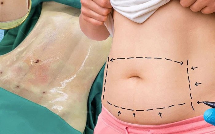After years of liposuction, Thuy Vi's navel shape looks strange - 8