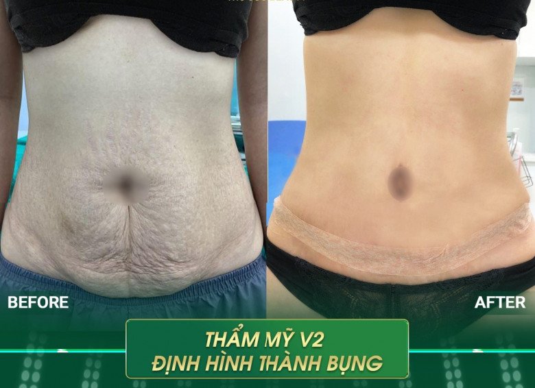 After many years of liposuction, Thuy Vi's navel shape looks strange - 10