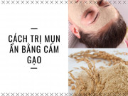 18 Cách trị mụn ẩn tại nhà bằng thiên nhiên an toàn hiệu quả nhất