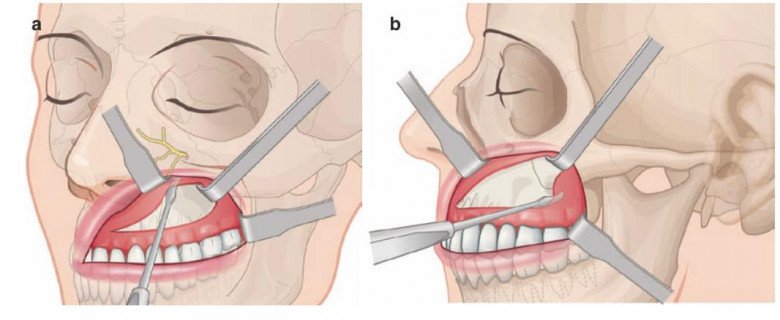 Đang niềng răng có gọt xương hàm, hạ gò má hay trượt cằm được không? - 10