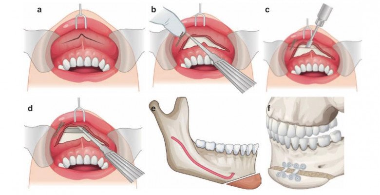 Đang niềng răng có gọt xương hàm, hạ gò má hay trượt cằm được không? - 9