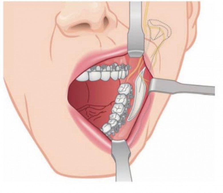 Đang niềng răng có gọt xương hàm, hạ gò má hay trượt cằm được không? - 8