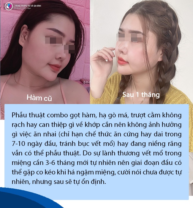 Đang niềng răng có gọt xương hàm, hạ gò má hay trượt cằm được không? - 12