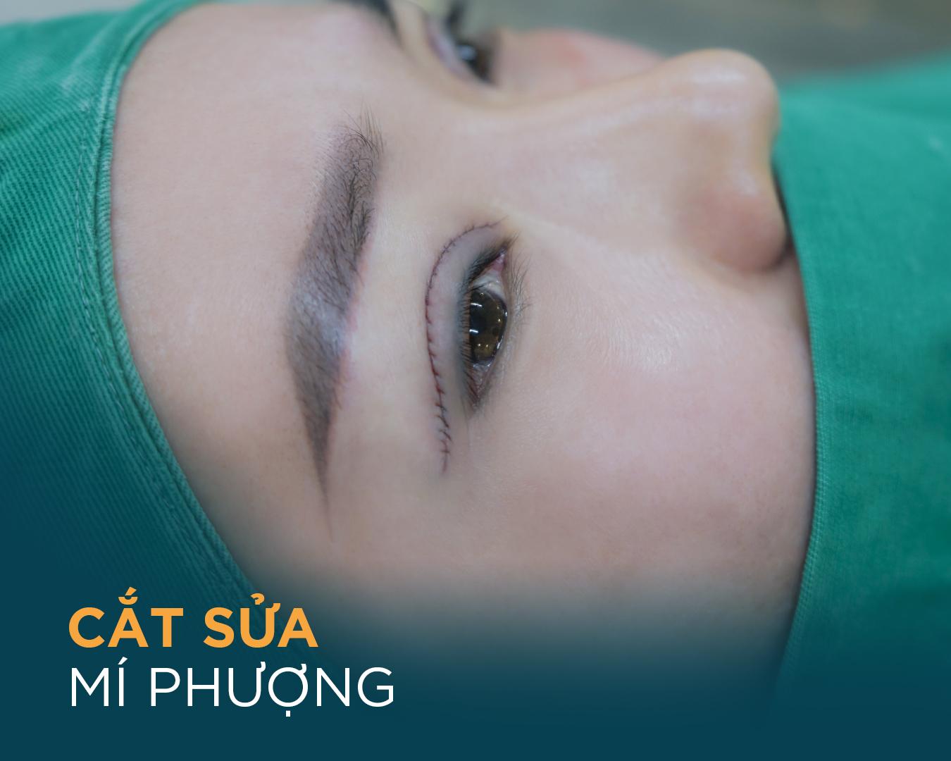 Phương pháp Cắt sửa mí Phượng độc đáo