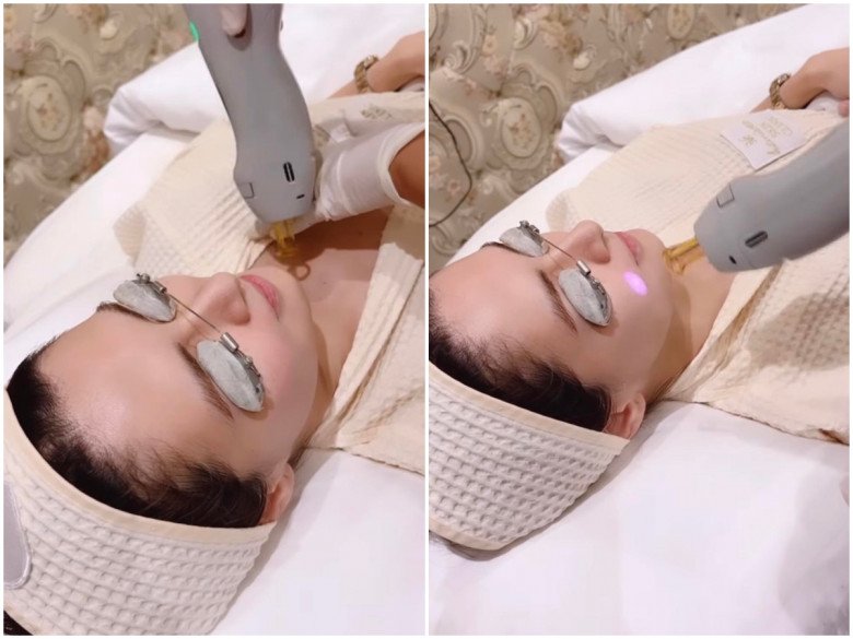 Trong đoạn clip, Marian Rivera đã thực hiện phương pháp dùng tia laser để tái tạo làn da. Có lẽ nhờ vào phương pháp làm đẹp chất lượng này mà da dẻ của nữ diễn viên sau bao năm qua vẫn duy trì độ trẻ trung không tuổi đáng ngưỡng mộ.