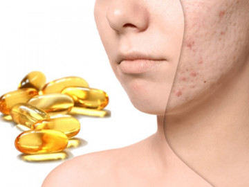 Cách trị và lấp đầy sẹo lõm lâu năm an toàn hiệu quả nhất hiện nay