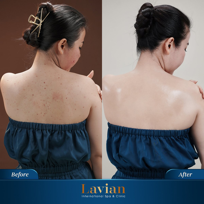 Ảnh trước và sau điều trị viêm nang lông của khách hàng Lavian