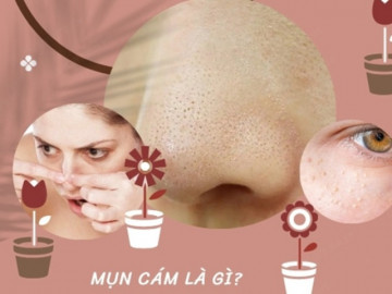 16 Cách trị mụn cám tại nhà hiệu quả nhanh nhất từ thiên nhiên