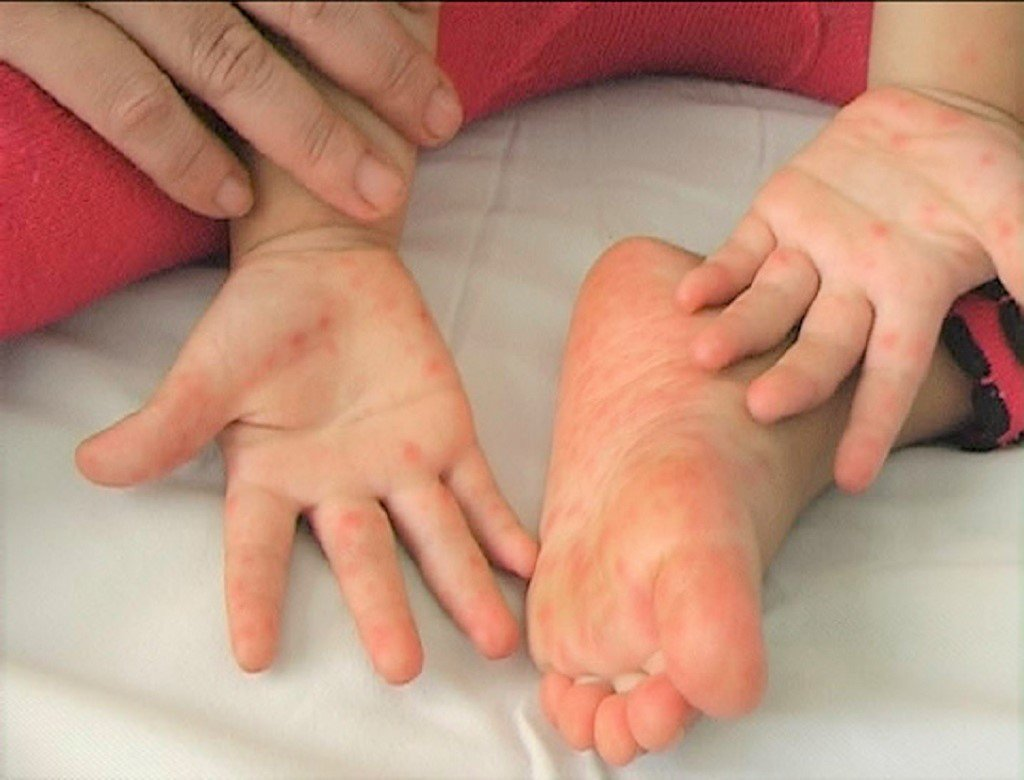 Bệnh tay chân miệng ở trẻ em bao lâu thì khỏi? - 3