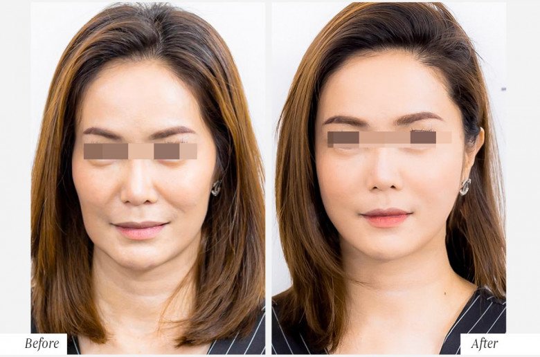 Các bài đăng quảng cáo hình ảnh trước và sau khi thực hiện tái sinh đa tầng có sự thay đổi ngỡ ngàng.