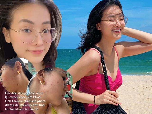 Phương Khánh tự bóc làn da kém xinh, thì ra Hoa hậu Trái Đất cũng có lúc bị mụn hành