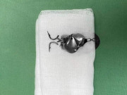 Sức khỏe - Bé trai bị lưỡi câu móc vào mắt, bác sĩ khuyến cáo tai nạn ít bố mẹ ngờ tới này