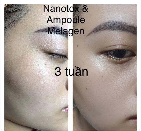 Vi kim gai Nanotox: Mỹ phẩm cao cấp này có thực sự an toàn và hiệu quả? - 2