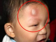 Làm mẹ - Con ngã từ trên giường xuống đất trán sưng to như quả ổi, mẹ trơ mắt đứng nhìn khiến bà nội tức giận nhưng BS khen