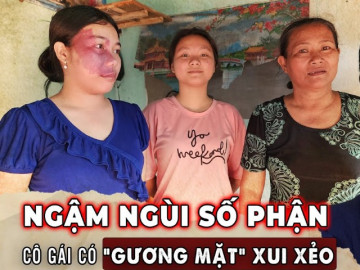 Cô gái 22 tuổi sở hữu gương mặt xui xẻo bị bạn bè xa lánh, không xin được việc làm và nỗi lòng người mẹ