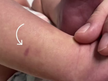 Con nổi ban đỏ như vết bầm ở chân, mẹ làm một việc nhỏ liền phát hiện ra ngay con đang gặp nguy hiểm
