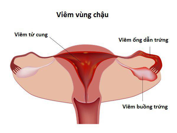 Khi bệnh Chlamydia không được điều trị, có thể gây bệnh viêm vùng chậu.