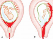 Bà bầu - Thai phụ ra huyết âm đạo ồ ạt coi chừng thai bám sẹo mổ cũ
