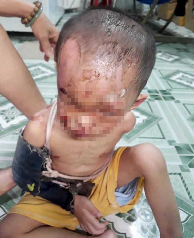 Bé trai bị bỏng nặng vùng mặt. Ảnh người dân cung cấp.