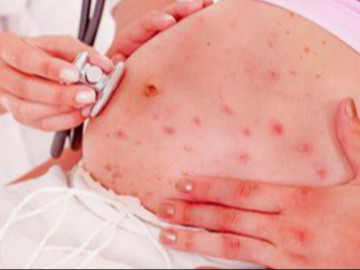 Thủy đậu nguy hiểm như thế nào đối với sức khỏe phụ nữ mang thai?