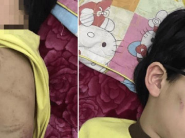 Nghi vấn cháu bé 8 tuổi ở Quảng Ninh bị mẹ đánh nhập viện do....chưa làm bài tập