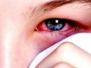 Clip Eva - Cảnh báo, đau mắt đỏ có thể bạn đã mắc COVID-19