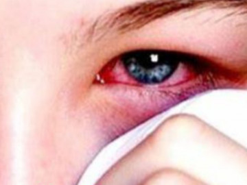 Cảnh báo, đau mắt đỏ có thể bạn đã mắc COVID-19