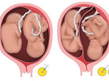 Xem hình ảnh siêu âm thai đôi qua các tuần thai để thấy sự kì diệu của tạo hóa