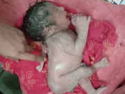 Tin tức - Em bé chào đời với cánh tay thứ 3 mọc sau lưng, hễ chạm vào là khóc toáng lên