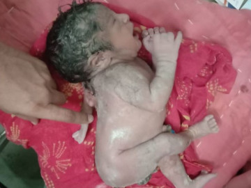 Em bé chào đời với cánh tay thứ 3 mọc sau lưng, hễ chạm vào là khóc toáng lên