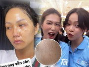 Làm đẹp - Khi Hoa hậu cũng nổi mụn lấm tấm, có cô từng dùng kem trộn vẫn khốn khổ vì làn da tuổi U30