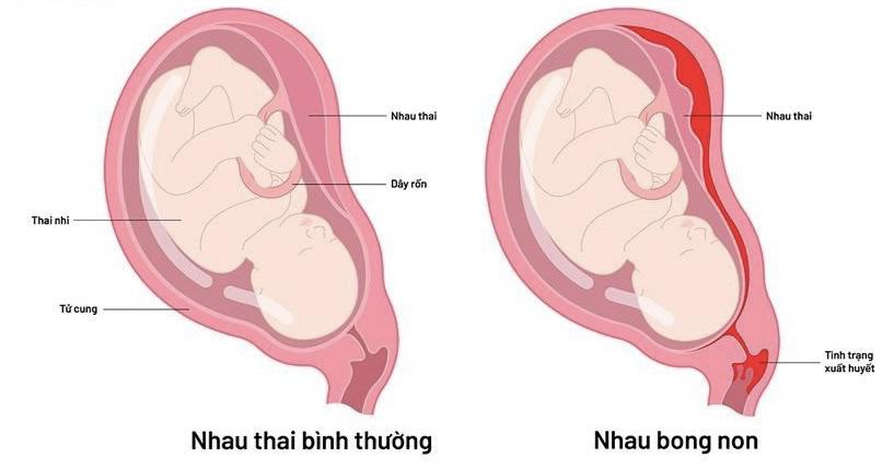 Các vấn đề về nhau thai cũng là nguyên nhân gây thai chết lưu.