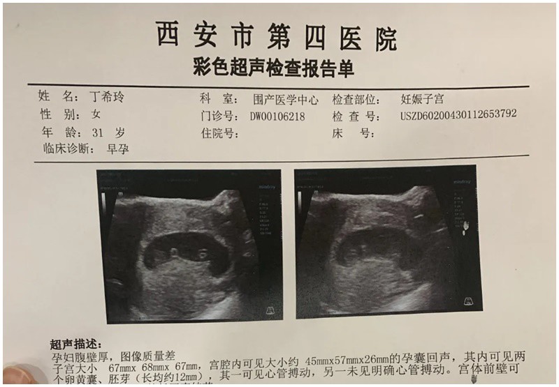 Một người mẹ ở Trung Quốc rất bất ngờ và hạnh phúc khi biết được mình mang song thai. Khi thai nhi được 9 tuần, cô bắt đầu ốm nghén nặng.
