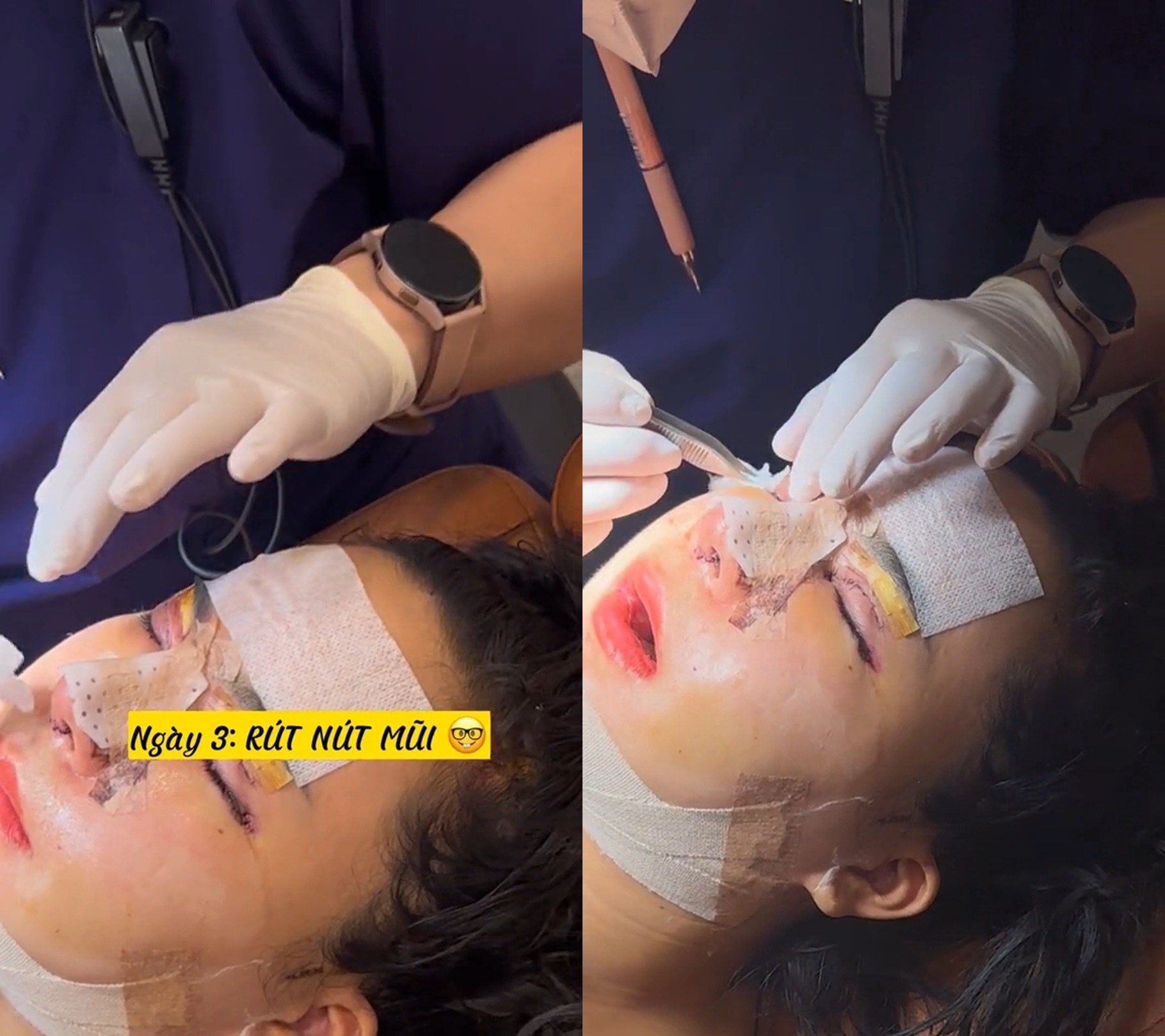 Sau 48 tiếng, cô được rút ống thông mũi và vệ sinh các vết khâu. Cô vui mừng chia sẻ, lúc này cuộc đời như thể nở hoa vì cô đã có thể... thở được bằng mũi.