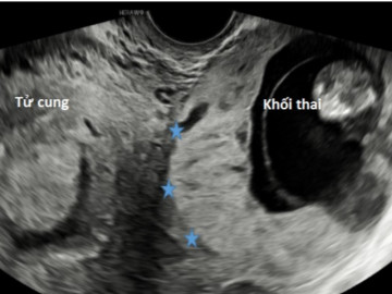 Đặt vòng nhưng vẫn có thai ở vị trí cực hiếm