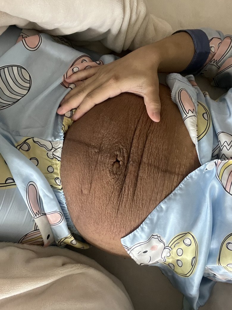 Phần bụng bị rạn, nhăn nheo, thâm đen sau bầu thai 3 nhưng chị Hương vẫn rất hạnh phúc và cảm thấy sự hy sinh này xứng đáng.